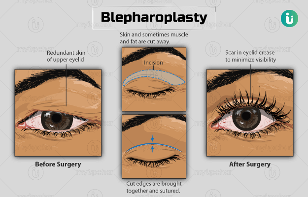 ब्लेफरोप्लास्टी - Blepharoplasty in Hindi