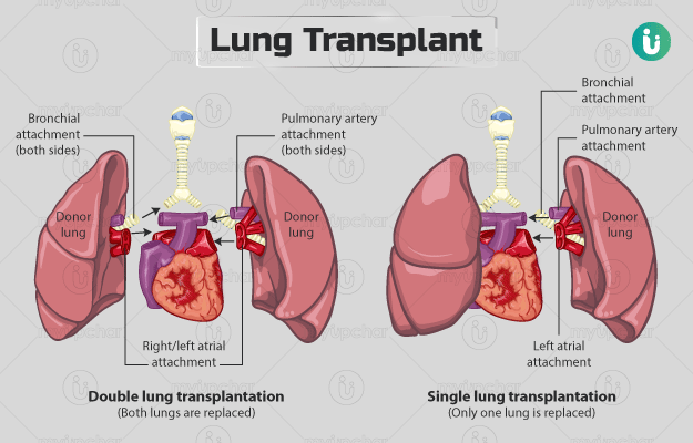फेफड़ों का ट्रांसप्लांट - Lung transplant in hindi