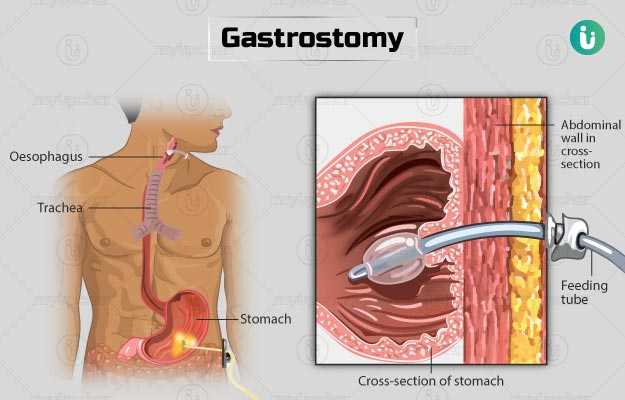 गैस्ट्रोटोमी - Gastrostomy in Hindi