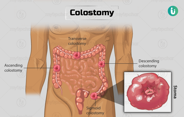 कोलोस्टोमी - Colostomy Surgery in Hindi