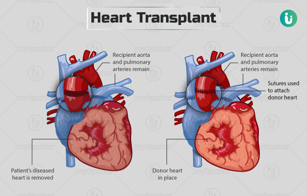 हार्ट ट्रांसप्लांट - Heart transplant in Hindi