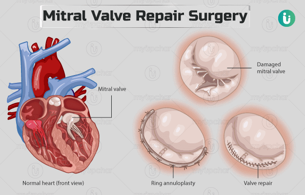 Mitral valve repair surgery
