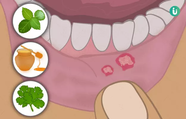 मुंह के छाले के घरेलू उपाय - Home Remedies for Mouth Ulcers in Hindi