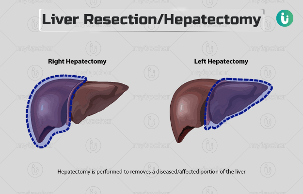 हेपेटेक्टमी - Hepatectomy in Hindi