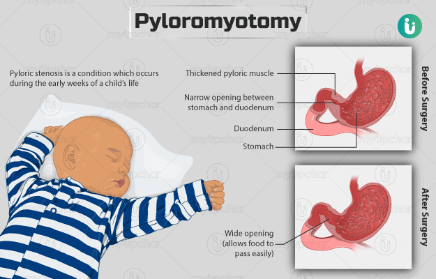 पाइलोरोमायोटमी - Pyloromyotomy in Hindi