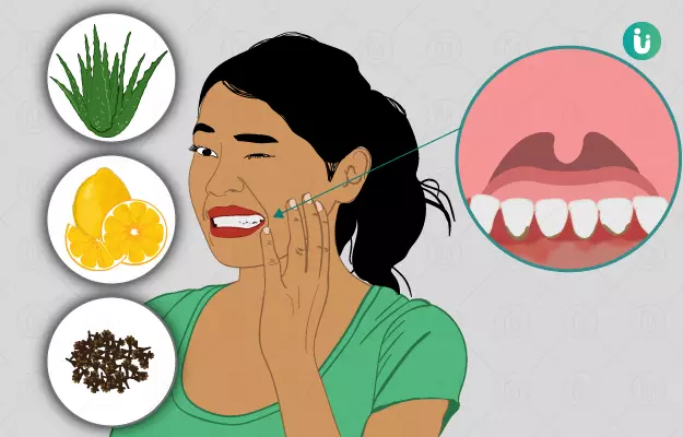 मसूड़ों में सूजन के घरेलू उपाय - Home Remedies for Gingivitis in Hindi