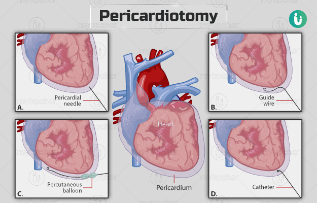 पेरीकार्डियोटोमी - Pericardiotomy in hindi