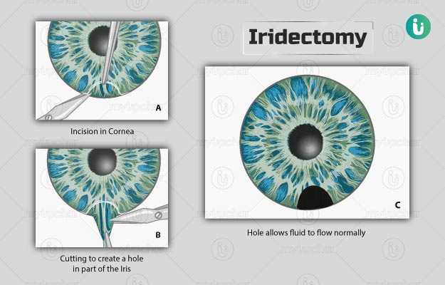 इरिडेक्टमी - Iridectomy