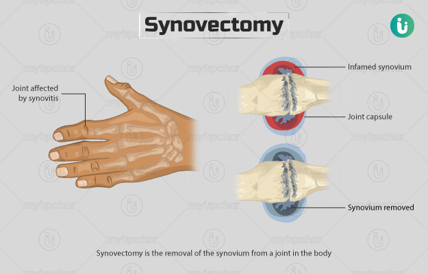साइनोवेक्टोमी - Synovectomy in Hindi
