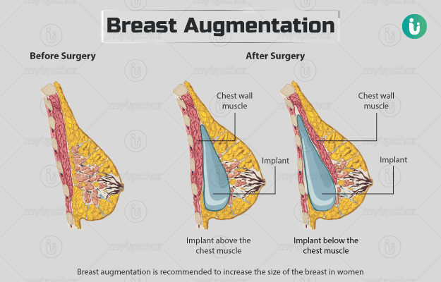 ब्रेस्ट का आकार बढ़ाने की सर्जरी - Breast augmentation in Hindi
