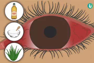 Say Goodbye to Pink Eye: Best At-Home Treatments for Conjunctivitis