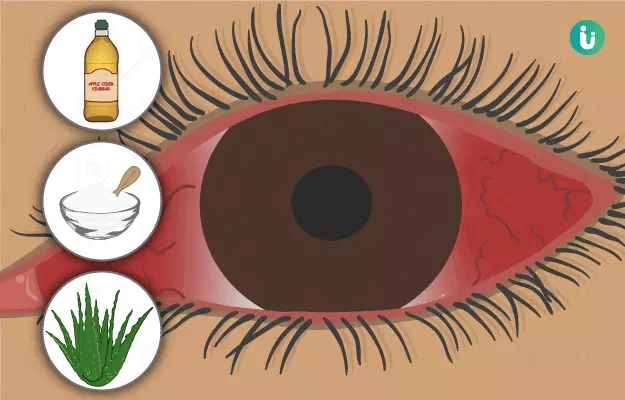आंख आने (कंजंक्टिवाइटिस) के घरेलू उपाय - Home Remedies for Conjunctivitis (Pink Eye) in Hindi