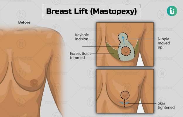 ब्रेस्ट लिफ्ट सर्जरी - Breast lift Surgery in Hindi