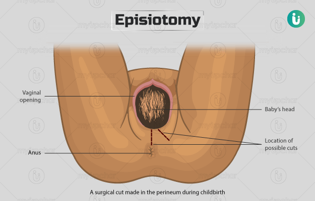 Episiotomy (perineotomy)