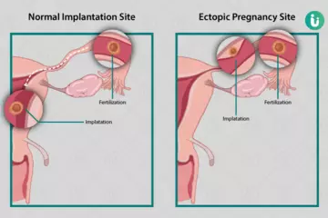 Ectopic Pregnancy: Life-Threatening Condition and Medical Solutions