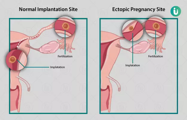 एक्टोपिक प्रेग्नेंसी (अस्थानिक गर्भावस्था) - Ectopic Pregnancy in Hindi