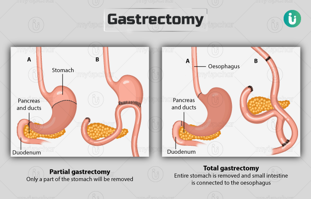 गैस्ट्रेक्टमी - Gastrectomy in Hindi