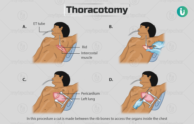 थोरैकोटोमी - Thoracotomy in hindi