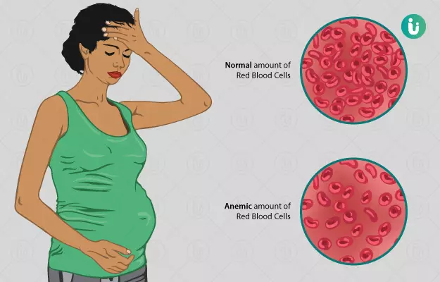गर्भावस्था में खून की कमी (एनीमिया) - Anemia during Pregnancy in Hindi