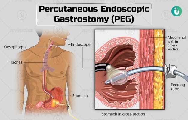 परक्यूटीनियस इंडोस्कोपिक गैस्ट्रोस्टॉमी - Percutaneous endoscopic gastrostomy in Hindi