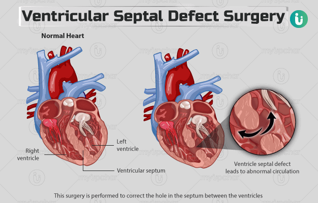 वेंट्रिकुलर सेप्टल डिफेक्ट सर्जरी - Ventricular septal defect surgery in Hindi