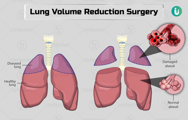 Lung volume reduction surgery