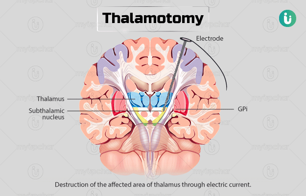 थैलमोटोमी - Thalamotomy in Hindi
