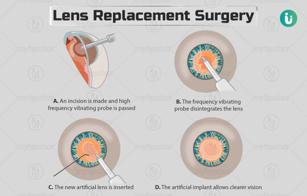 लेंस प्रतिस्थापन सर्जरी - Lens replacement surgery in Hindi
