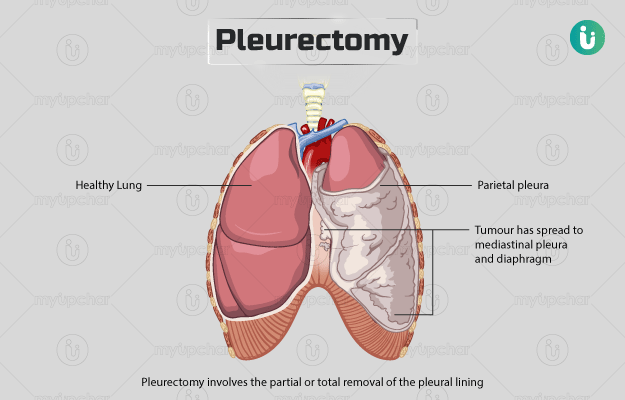 प्ल्यूरेक्टोमी (परिफुप्फुसोच्छेदन) - Pleurectomy in Hindi