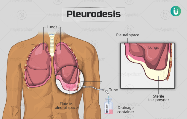 प्ल्यूरोडेसिस - Pleurodesis in Hindi