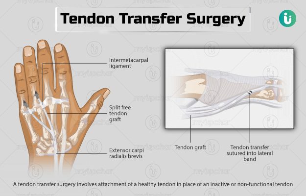टेंडन ट्रांसफर सर्जरी - Tendon Transfer Surgery in Hindi