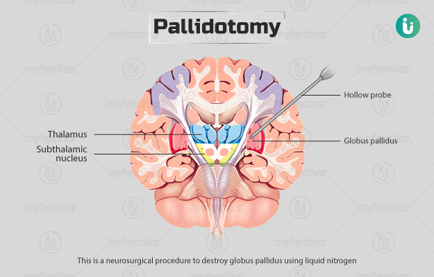 पैलिडोटोमी (पार्किंसंस रोग के लिए सर्जरी) - Pallidotomy in Hindi