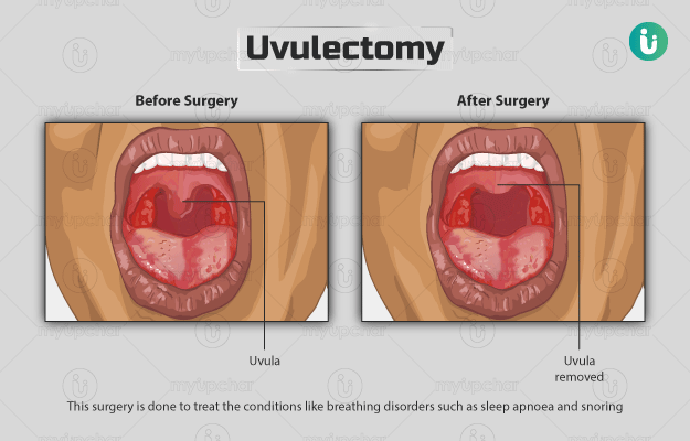 यूवुला हटाने की सर्जरी (यूवुलेक्टोमी) - Uvulectomy in Hindi