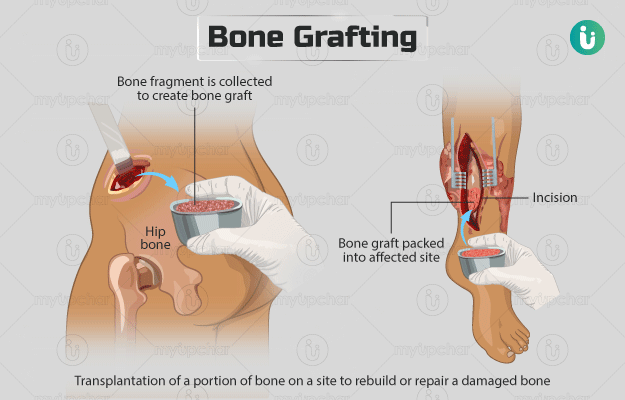 Bone Grafting Procedure Purpose Results Cost Price