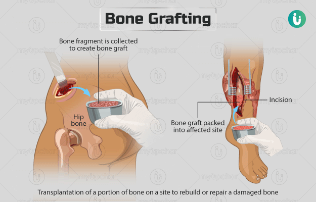 बोन ग्राफ्टिंग सर्जरी (अस्थि निरोपण) - Bone grafting in Hindi