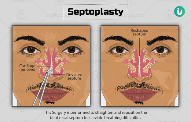 miljøforkæmper Polering afsnit Septoplasty: Procedure, Purpose, Results, Cost, Price