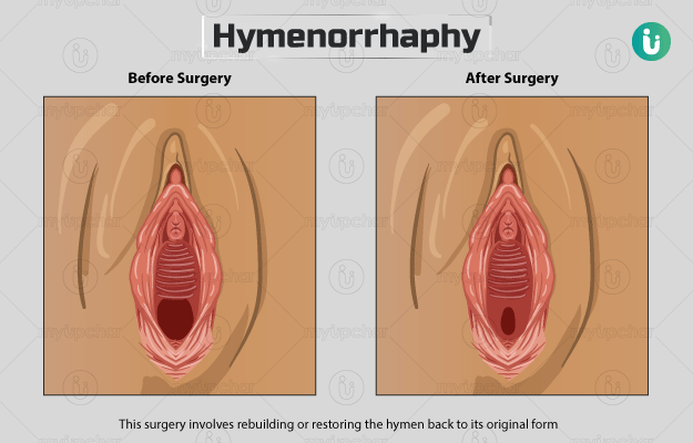 हाइमनोप्लास्टी - Hymen reconstruction surgery in Hindi