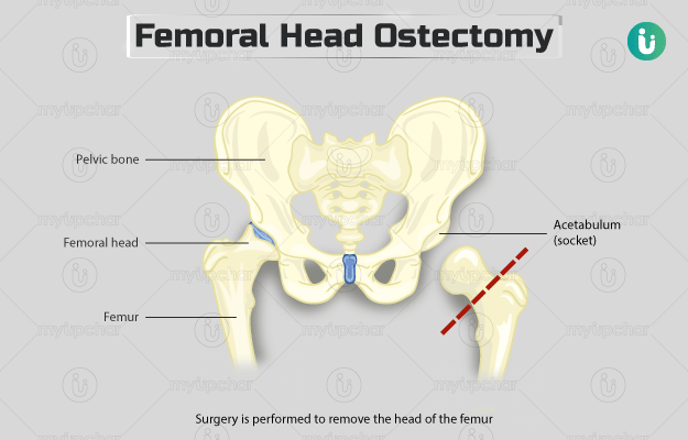 फेमोरल हेड ओसेक्टोमी (ऊरु शीर्ष अस्थि उच्छेदन) - Femoral head ostectomy in Hindi