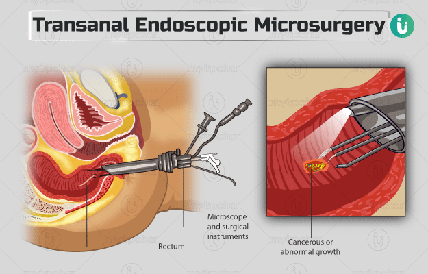 ट्रांस-एनल एंडोस्कोपिक माइक्रोसर्जरी - Transanal Endoscopic Microsurgery (TEM) in Hindi