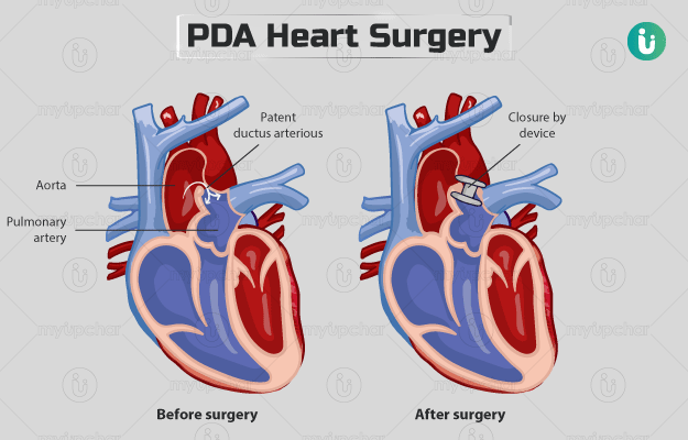Patent Ductus Arteriosus (PDA) Heart Surgery