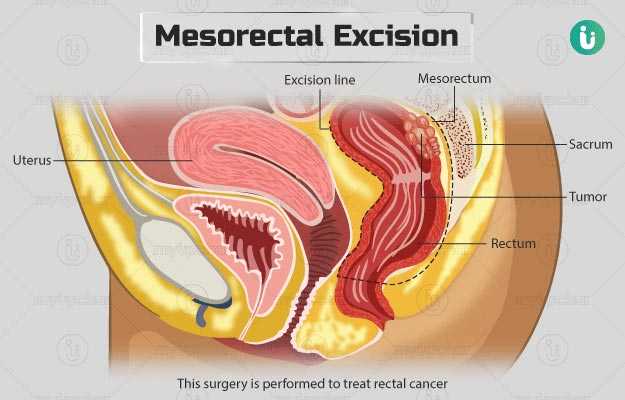Mesorectal excision