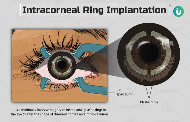 Intracorneal ring segment implantation