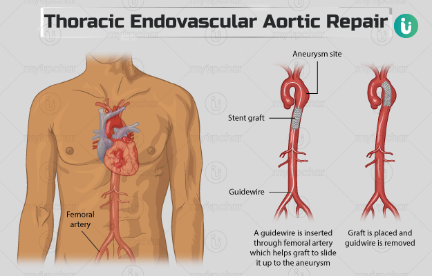 थोरेसिक एंडोवस्कुलर एरोटिक रिपेयर (टीईवीएआर) - Thoracic Endovascular Aortic Repair (TEVAR) in Hindi