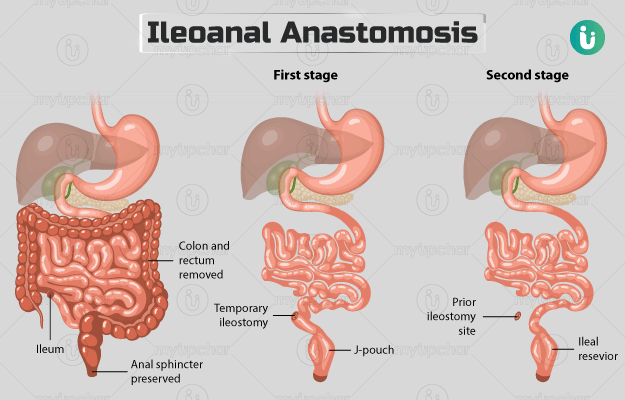 इलियल-पाउच एनल एनास्टोमोसिस (जे-पाउच सर्जरी) - Ileoanal Anastomosis (J-pouch surgery) in Hindi