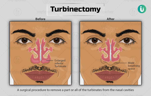 टर्बिनेक्टमी - Turbinectomy in Hindi