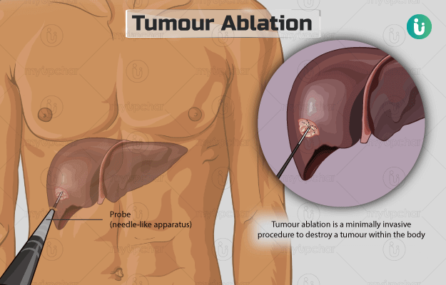 ट्यूमर उच्छेदन - Tumor ablation in Hindi