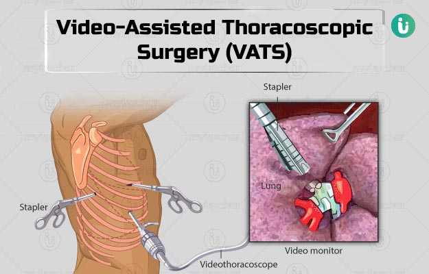 वीडियो-असिस्टेड-थोरेकोस्कोपिक सर्जरी - Video-assisted thoracoscopic surgery (VATS) in Hindi