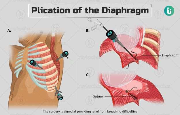 प्लिकेशन ऑफ डायाफ्राम - Plication of the Diaphragm in Hindi