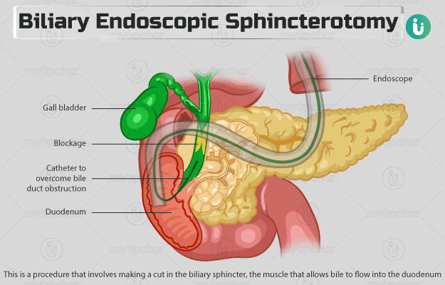 बाइलरी एंडोस्कोपिक स्फिंक्टरोटॉमी - Biliary Endoscopic Sphincterotomy in Hindi