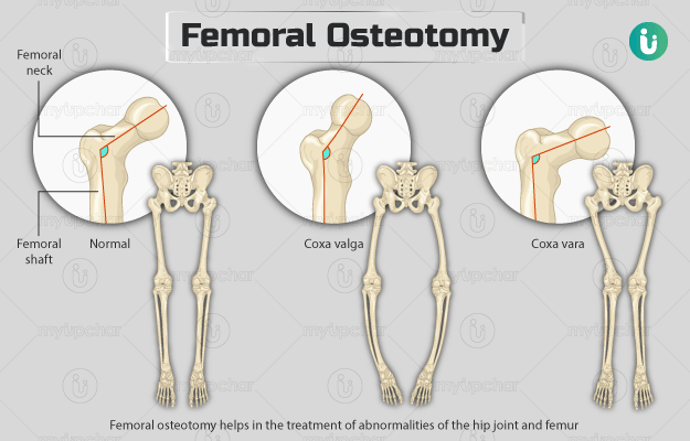 फेमोरल ऑस्टियोटोमी - Femoral Osteotomy in Hindi
